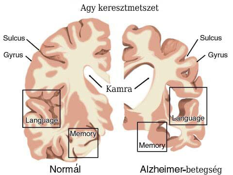  Alzheimer-betegségben szenvedő beteg agya